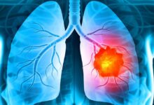 How to Identify the Best Cancer Hospital for Long-Term Treatment